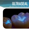 Trám bít hố rãnh UltraSeal XT Plus (A2, White) Trám bít hố rãnh UltraSeal XT Plus (A2, White)