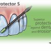 Fluor protector Gel Fluor protector Gel