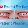 Ngừa sâu răng Enamel Pro Varnish Ngừa sâu răng Enamel Pro Varnish