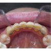 Thanh cố định mặt lưỡi Lingual Retainer Thanh cố định mặt lưỡi Lingual Retainer