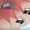 Nút Turbos Opener kê khớp Nút Turbos Opener kê khớp